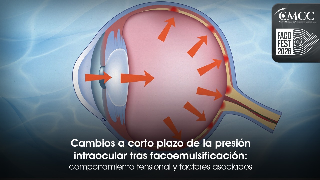 Cambios a corto plazo de la presión intraocular tras facoemulsificación: comportamiento tensional y factores asociados